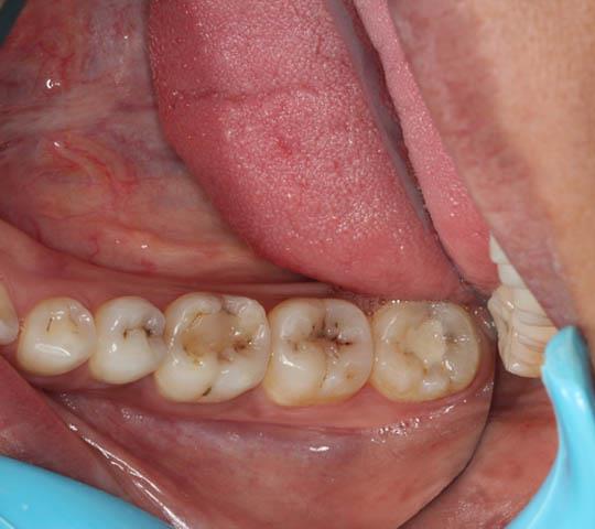 Multiple Decayed Teeth in quadrant