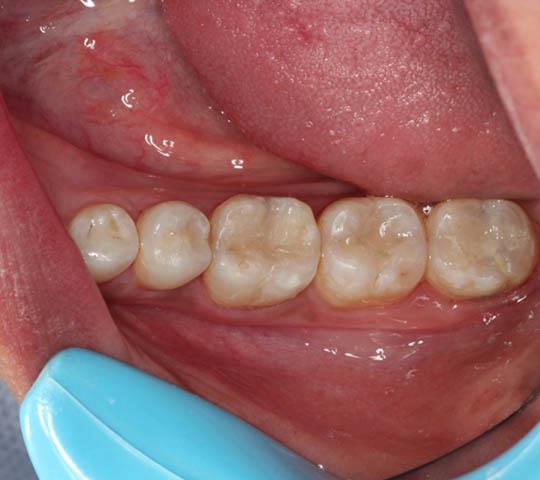 Restoration of All Teeth