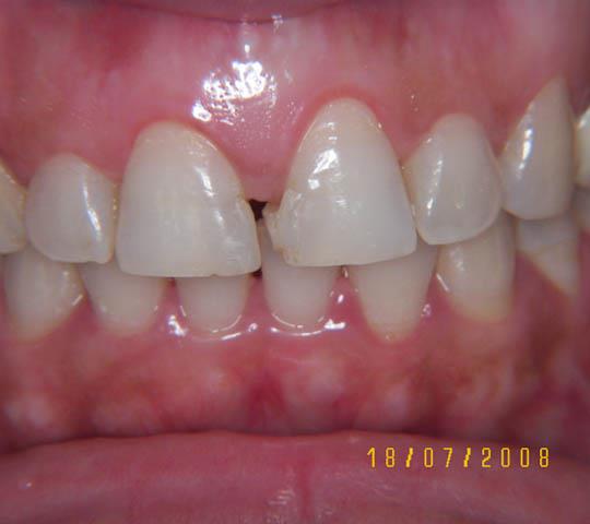 Before Treatment