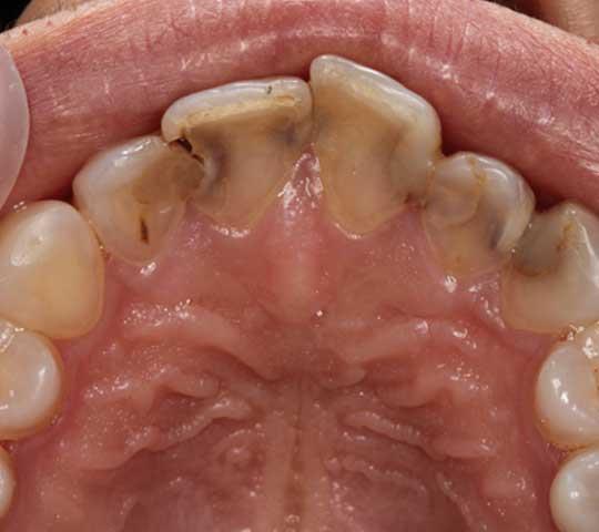 Inside View of Decaying Front Teeth