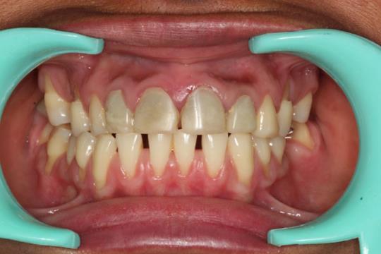 Bad Looking Crowns on Front Teeth from elsewhere - Before Treatment
