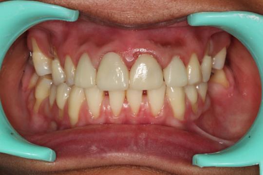 After Treatment With Metaless Crown