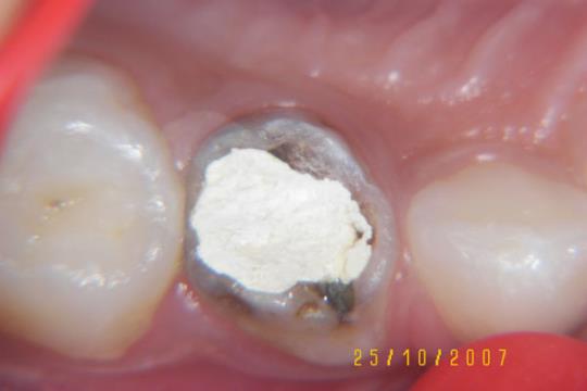 Badly decayed teeth with very less structure - Before Treatment