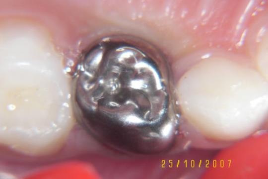 After Treatment - Pre Formed Crowns give strength and longetivity to tooth