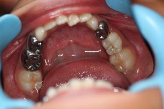 Lower teeth after treatment - chewing surface