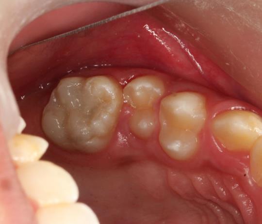 After  - Filling of Permanent teeth in children