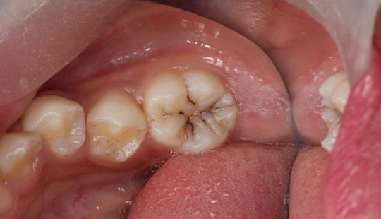 Before - Filling of Permanent teeth in children