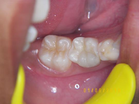 Upper Teeth - After Treatment - chewing surface view