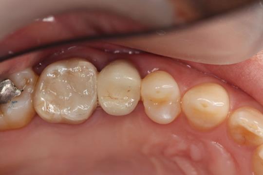 After Implant Adjacent tooth also filled