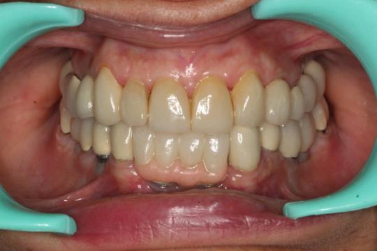 After Implants and Full Mouth rehabilitation