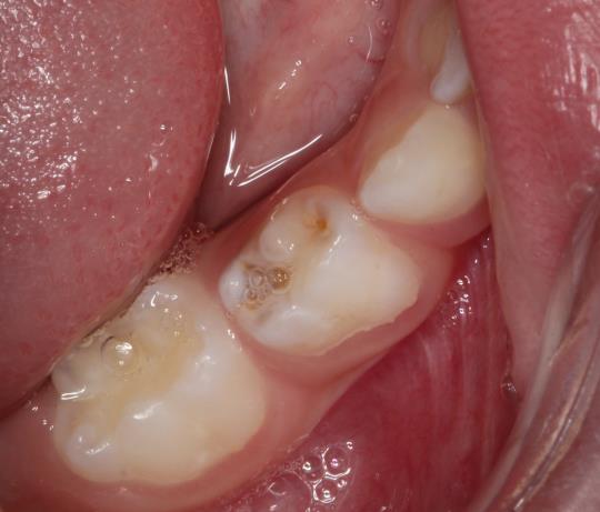 Before Treatment - Filling of Permanent teeth in children