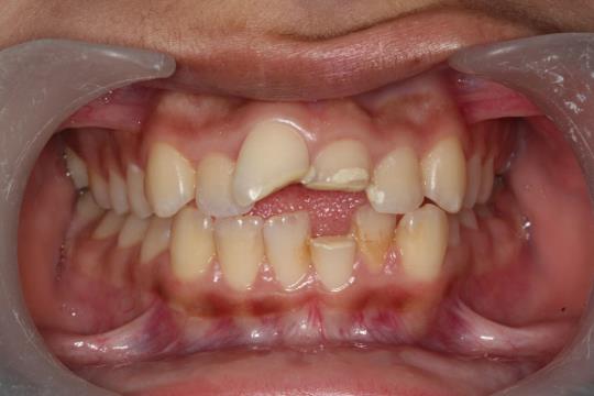 Before Treatment - Broken teeth