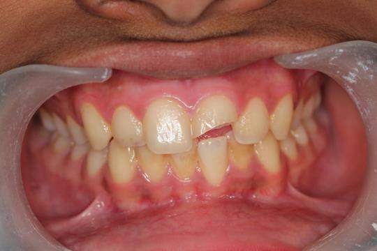 Before Treatment- Broken Teeth