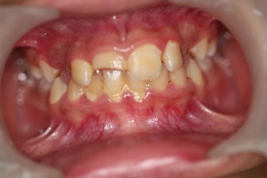 Before Treatment - Broken teeth